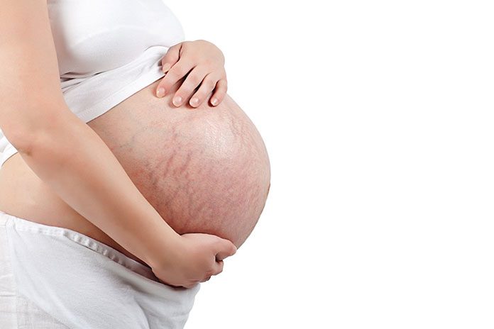 Rozstępy podczas ciąży - jak zapobiec ich powstaniu?